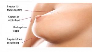 Breast Cancers Symptoms| 5 signs of breast cancer that you did not know