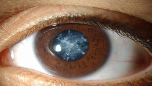 Cataracts | 7 things you need to know about cataracts